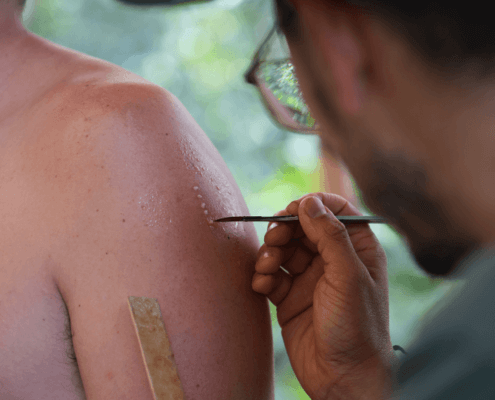 Auftragen von Kambo auf kleine Punkte, die in die Haut gebrannt wurden